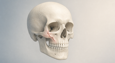 Simplified skull illustration highlighting a facial fracture in a restrained clinical color palette