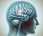 intravenous tirofiban after tenecteplase in acute ischemic stroke