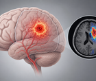 Brain MRI perfusion illustration highlighting hyperperfused glioma region on arterial spin labeling