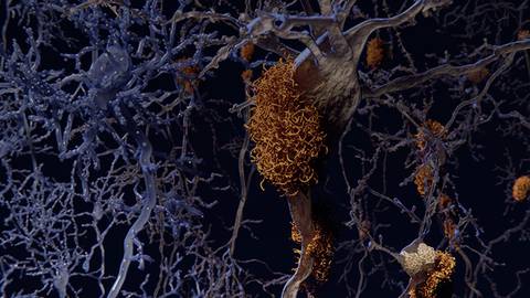 A Look at Lecanemab: The Latest Breakthrough in Alzheimer’s Treatment