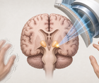 Simplified brain illustration highlighting the thalamus in Parkinsons disease tremor treatment