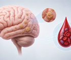 Illustration of brain beta amyloid pathology with a blood drop symbolizing PrecivityAD2 APS2 testing