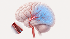 choice 2 trial intra arterial alteplase after thrombectomy