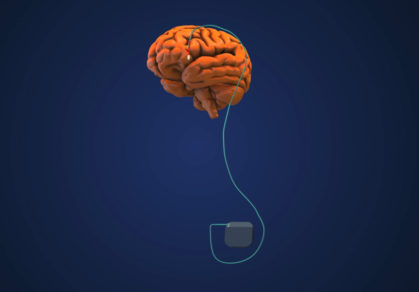Deep Brain Stimulation Shows Immediate Improvement in Arm and Hand ...